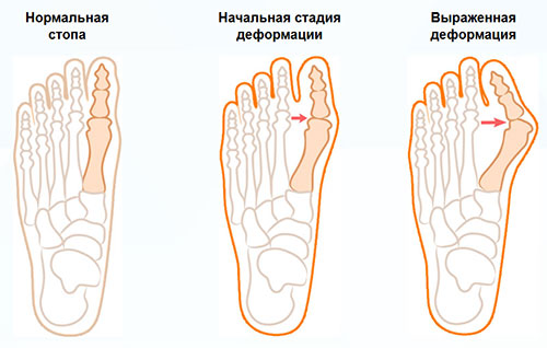 Лечение косточки на большом пальце ноги. Фиксаторы ортопедические для коррекции