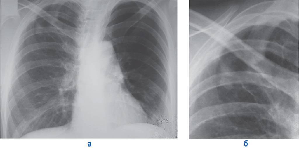 Виды очагового туберкулеза лёгких: заразен он или нет, как излечиться