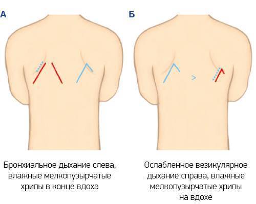 Везикулярное дыхание схема