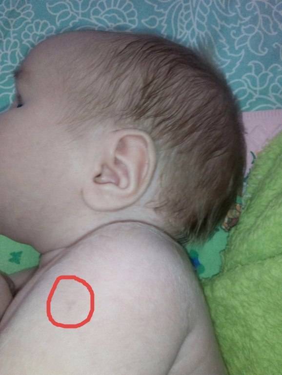 Бцж  и желтушка....делали ли вам при выписке эту прививку если билирубин упал до нормы? - запись пользователя ната (mamylkanatylka) в сообществе здоровье новорожденных в категории желтуха новорожденных - babyblog.ru