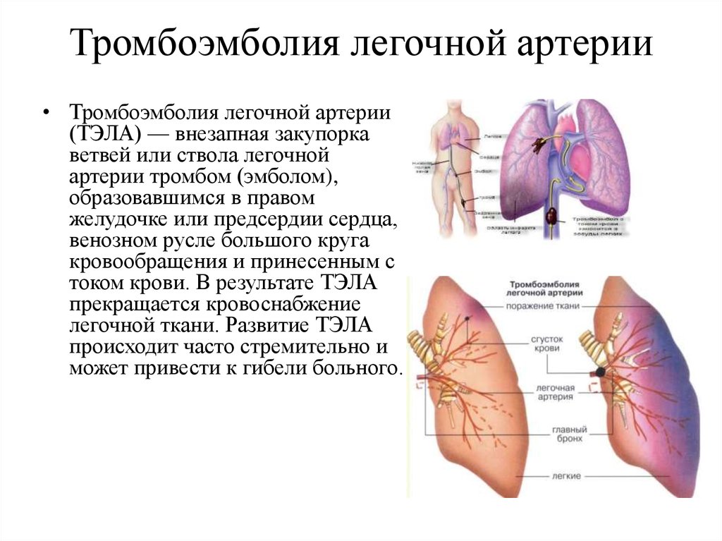 Тромбоэмболия легочной артерии. причины, симптомы, признаки, диагностика и лечение патологии.