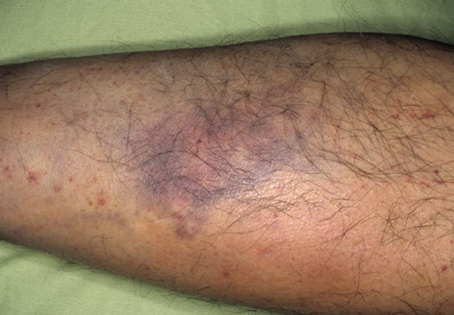 Тромбоцитопения (пурпура) | симптомы | диагностика | лечение - docdoc.ru