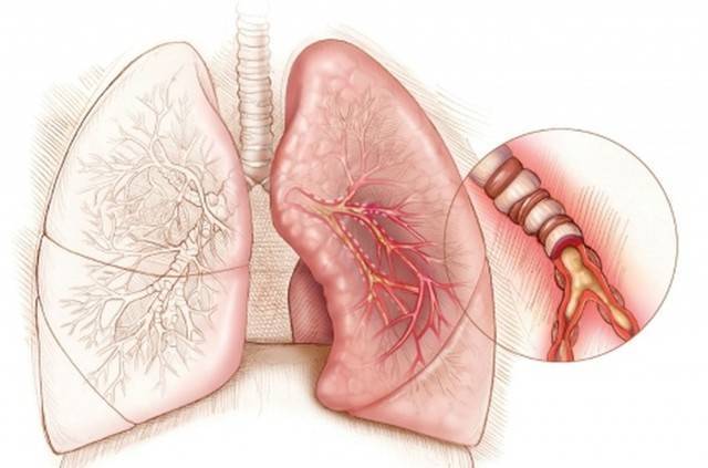Первые признаки астмы у взрослого человека