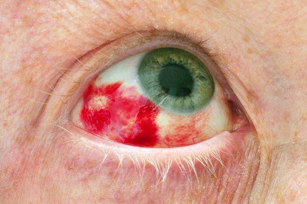 Кровоизлияние в глаз: что делать, причины и лечение, симптомы, диагностика