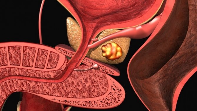 Питание и диета при раке предстательной железы