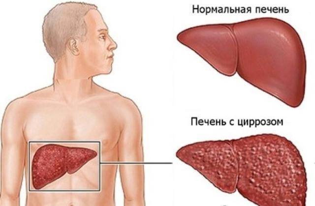 При кашле болит справа под ребрами сбоку что