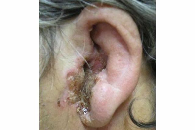Грибок в ушах у человека — фото, лечение, симптомы, причины