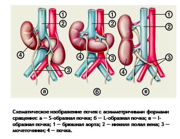 Подковообразная почка у ребенка чем опасна