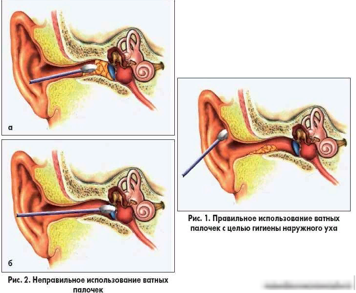 Пробки в ушах у ребёнка: причины, симптомы, что делать, осложнения