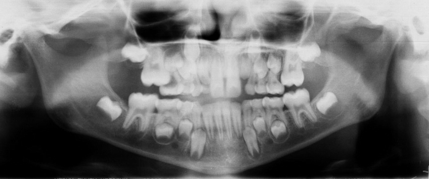 Киста на корне зуба — удалять или лечить?