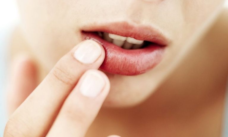 Причины появления и методы лечения заед в уголках рта