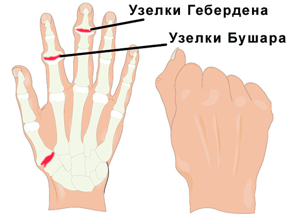 Ревматоидный артрит пальцев рук