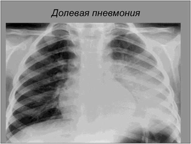 Пневмония или туберкулёз?