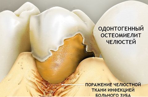 Одонтогенный остеомиелит челюсти
