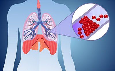 Причины, лечение и прогноз для жизни при тромбоэмболии легочной артерии