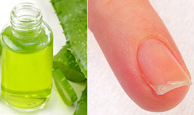 Ломкие ногти на руках: причины, лечение, витамины