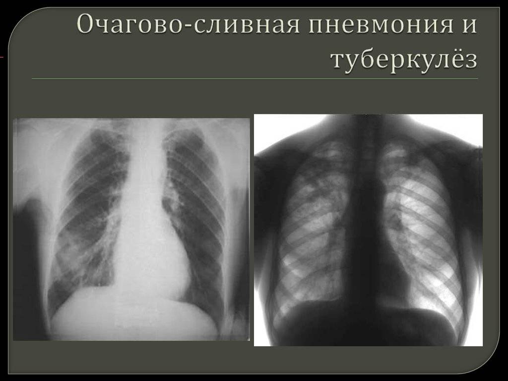 Как отличить туберкулез от пневмонии: по симптомам, анамнезу, физикальной диагностике