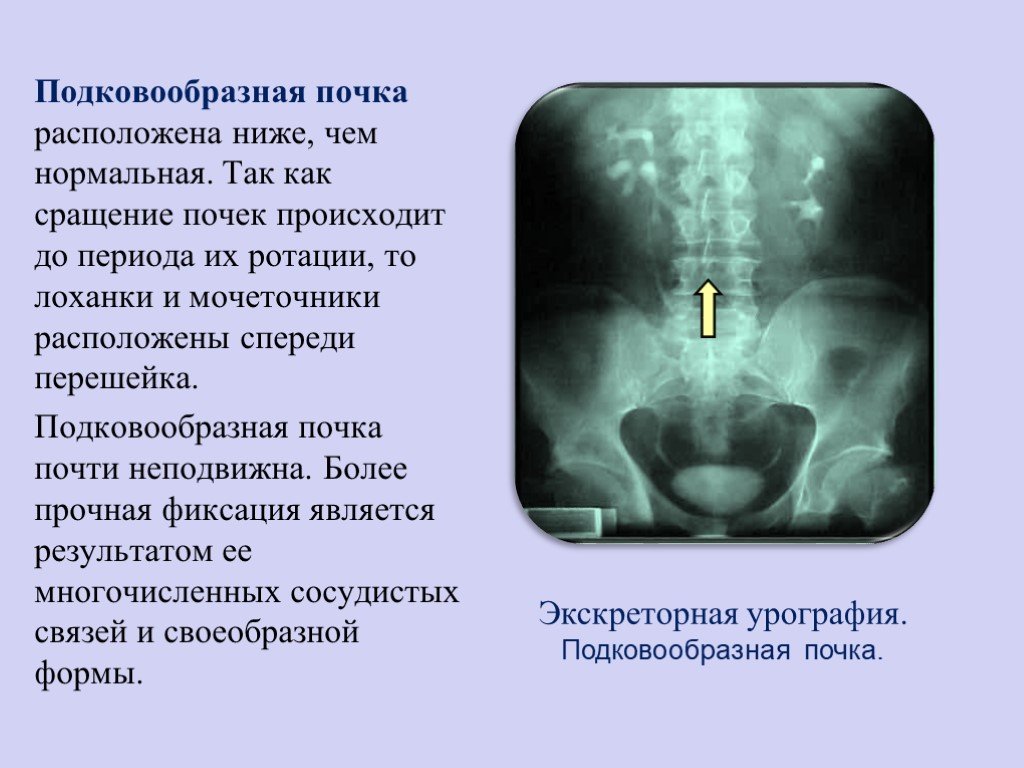 Подковообразная почка у ребенка чем опасна