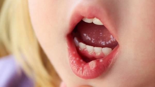 Жжение и неприятные ощущения во рту и на языке причины и лечение