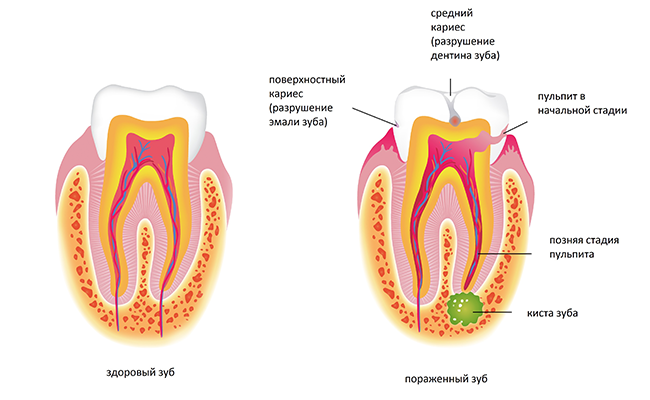 Гранулема корня зуба: хирургическое и консервативное лечение
