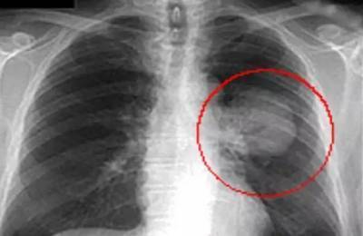 Туберкулема легких что это такое заразен или нет
