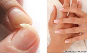 Что делать, когда сильно слоятся ногти?