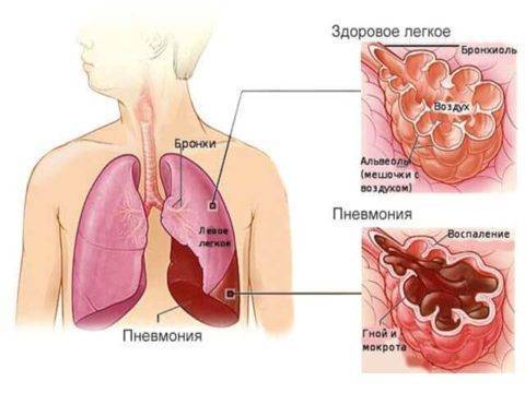 Анализ крови при пневмонии: симптомы, подготовка и расшифровка