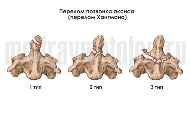 Компрессионный перелом позвоночника у детей: лечение и реабилитация, симптомы и последствия, при переломе грудного отдела