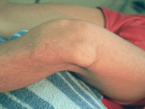 Гнойный бурсит локтевого сустава: причины развития и лечение патологии