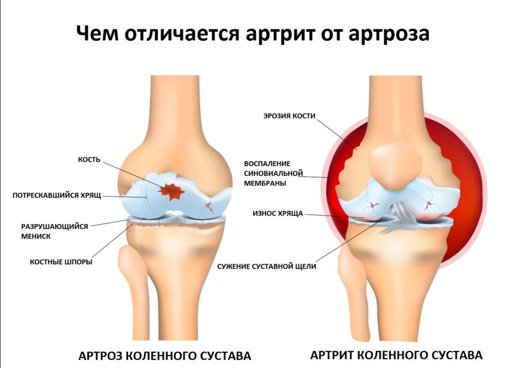 Гонартроз коленного сустава схема лечения