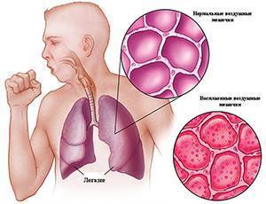 Основные признаки и симптомы пневмонии без температуры у взрослых