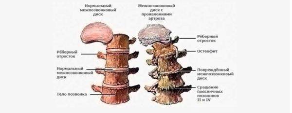 Спондилез поясничного отдела позвоночника фото