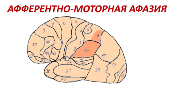 Характеристика афферентной моторной афазии