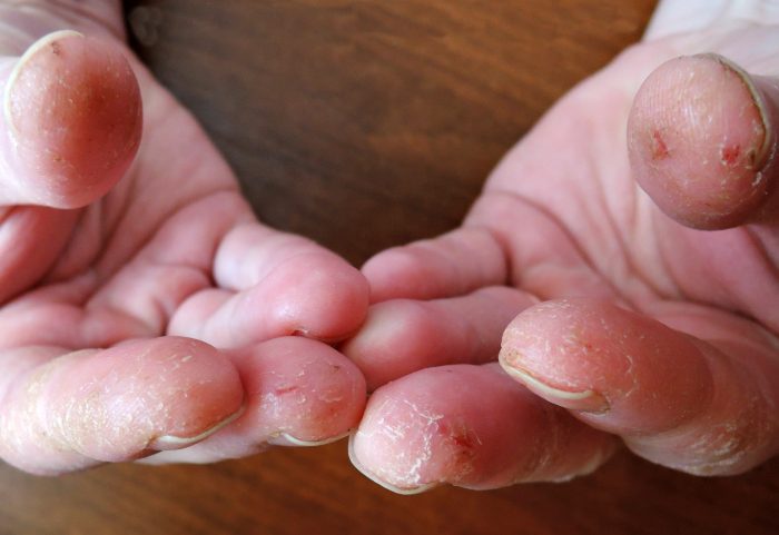 Грибок ногтей на руках: фото, симптомы, лечение
