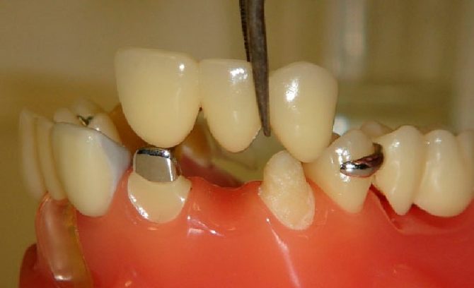 Восстановление (протезирование) зубов. металлокерамика, мостовидные протезы, зубные коронки
