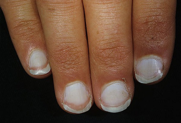 Женщина увидела странные полосы на ногтях. кто бы мог подумать, что это спасет ей жизнь!