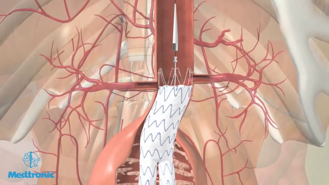 Коварная аневризма аорты сердца — что это такое, как диагностировать и вылечить?