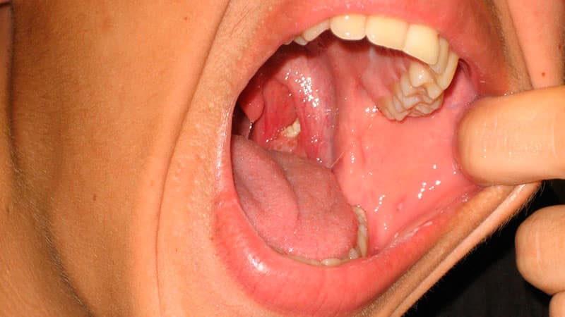 Язвы во рту: почему появляются и способы лечения - много зубов