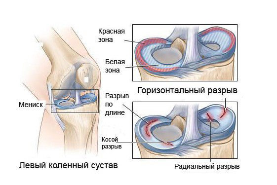 Разрыв мениска коленного сустава: лечение, операция, как долго будет заживать