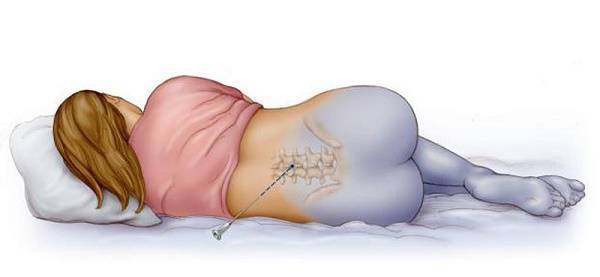 Болит спина после эпидуральной анестезии причины лечение