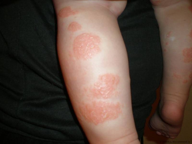 Как проявляется атопический дерматит у детей: симптомы и лечение