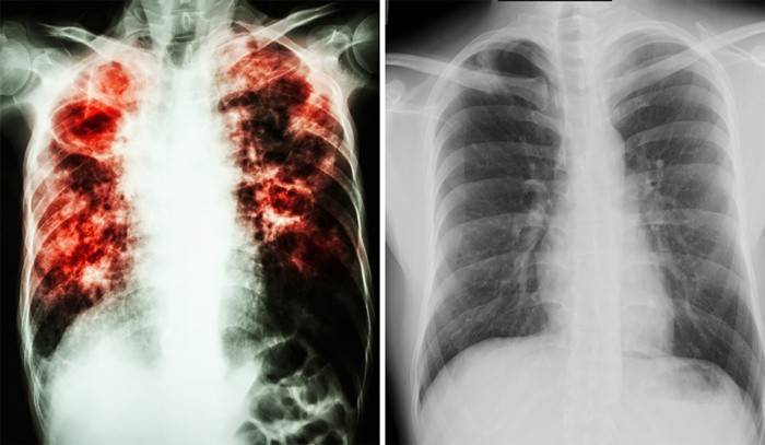 Отличия открытой и закрытой формы туберкулеза