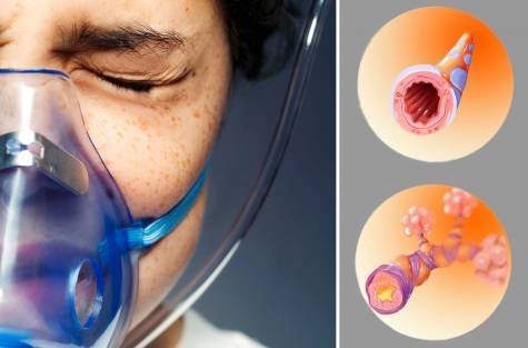 Бронхиальная астма. причины, симптомы, современная диагностика и эффективное лечение :: polismed.com