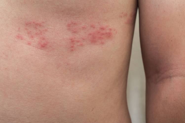 Микоз кожи: симптомы на фото, как происходит лечение на начальной стадии, какие препараты и мази использовать при грибовидном микозе, а также их виды