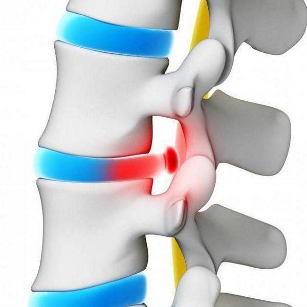 Карипазим при грыже позвоночника отзывы цены