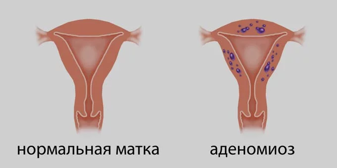 Является ли аденомиоз матки раком: описание заболевания и злокачественные образования