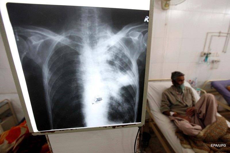 Виды туберкулеза и их особенности