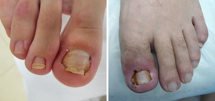 Вросший ноготь. причины, симптомы, операция удаления ногтя и реабилитация. :: polismed.com