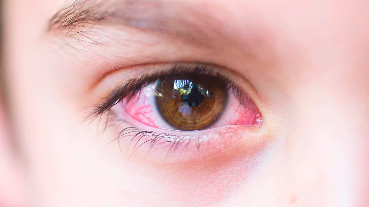 Глазное давление - симптомы и лечение. нормальное глазное давление у взрослых и детей, как снизить до нормы
