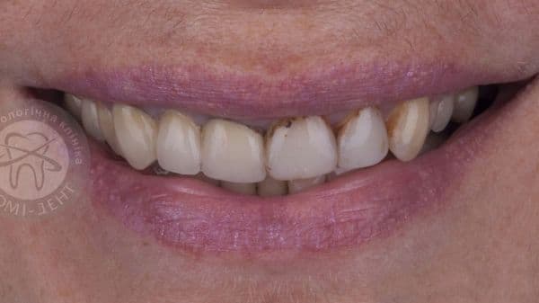 Как восстановить эмаль зубов